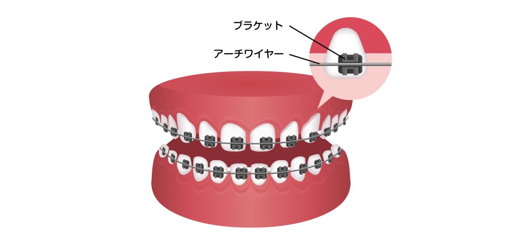 三ノ宮 矯正 ワイヤー矯正