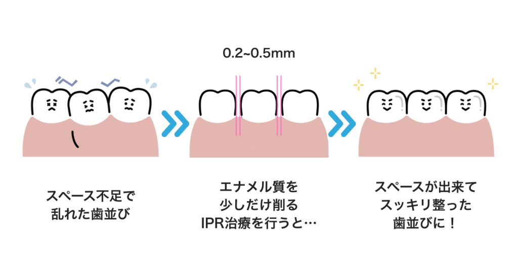 マウスピース矯正におけるIPR（歯間削合）の説明図｜歯を抜かずにスペースを確保する方法