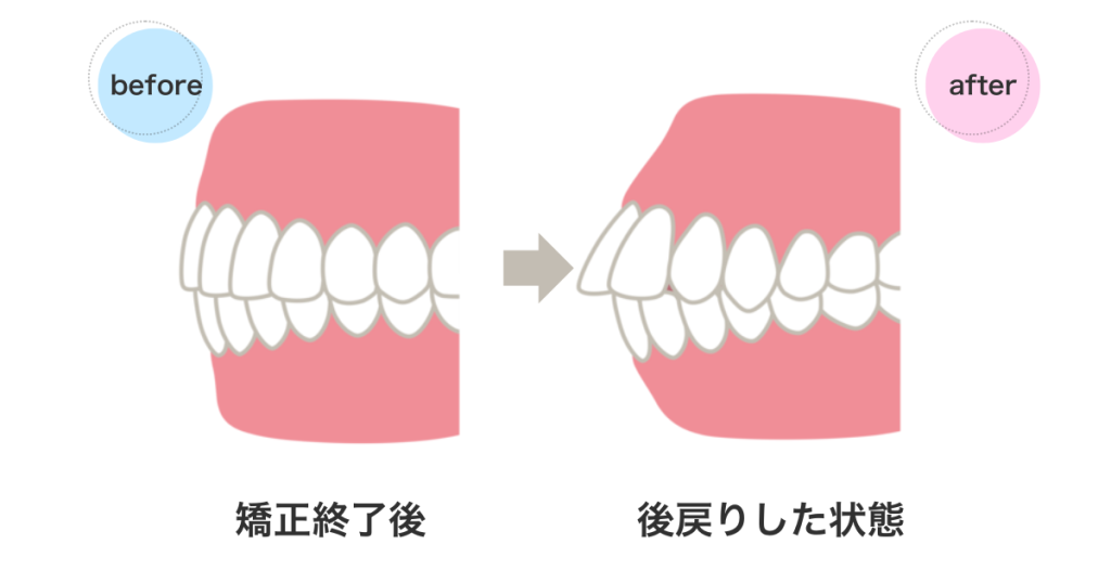 マウスピース矯正の後戻りビフォーアフター｜矯正終了後に歯が動く状態を示す比較画像