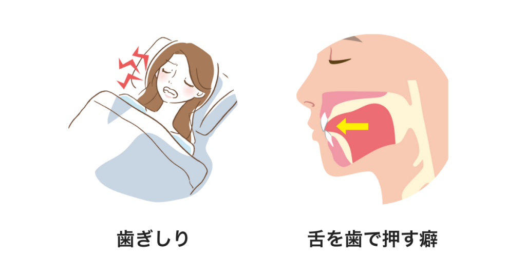 歯ぎしりと舌癖が原因の歯並びの後戻り｜マウスピース矯正中の注意点