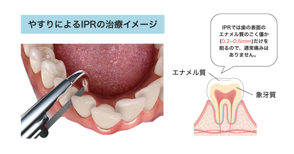 IPR処置の量と痛みの目安｜マウスピース矯正中の安全な歯間削合