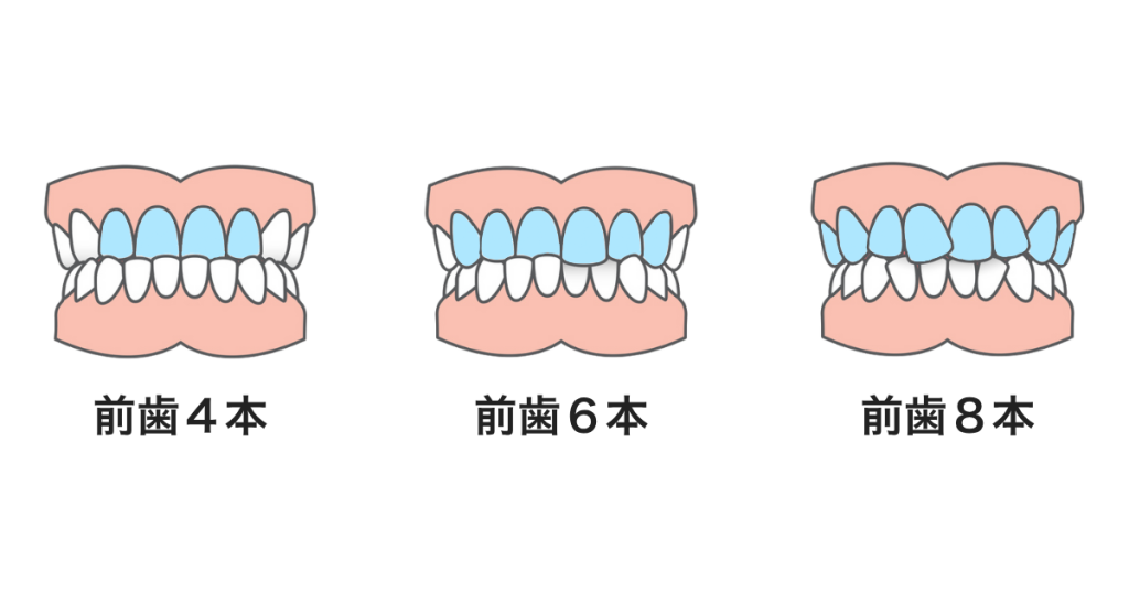 セラミック矯正で治療する本数による見た目の変化を比較した画像