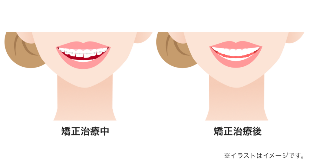 矯正によって整った口元と自然な笑顔に変化する過程を示すイメージ