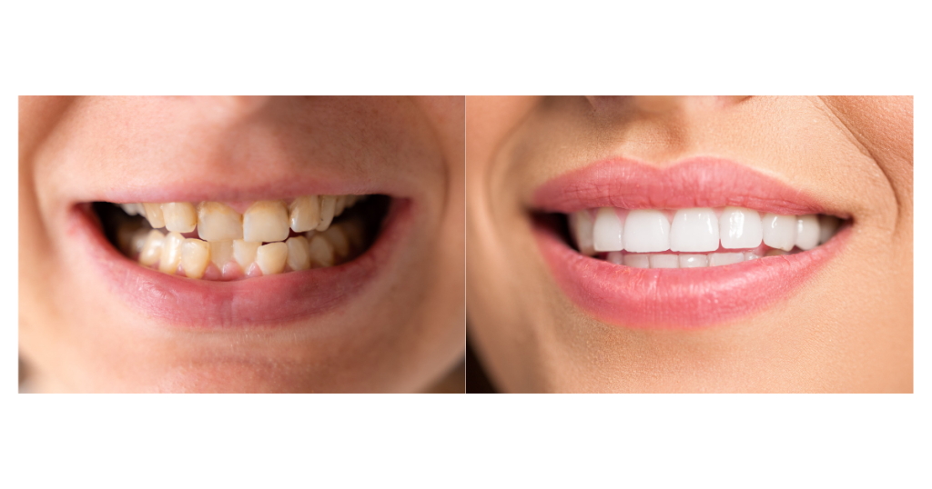 整った歯並びと乱れた歯並びの笑顔の違いを比較する図解