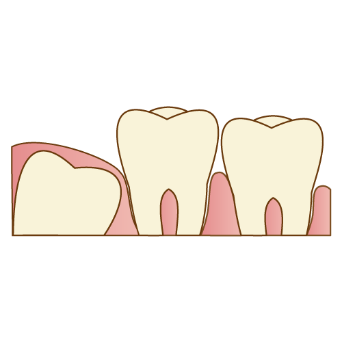 正常に生えた親知らずの症例と歯列矯正の関係