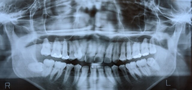 親知らずが歯列に悪影響を与える様子