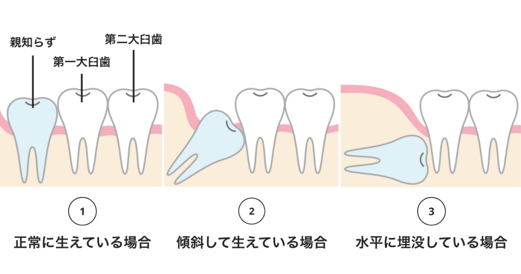 親知らずの生え方の種類を比較したイラスト