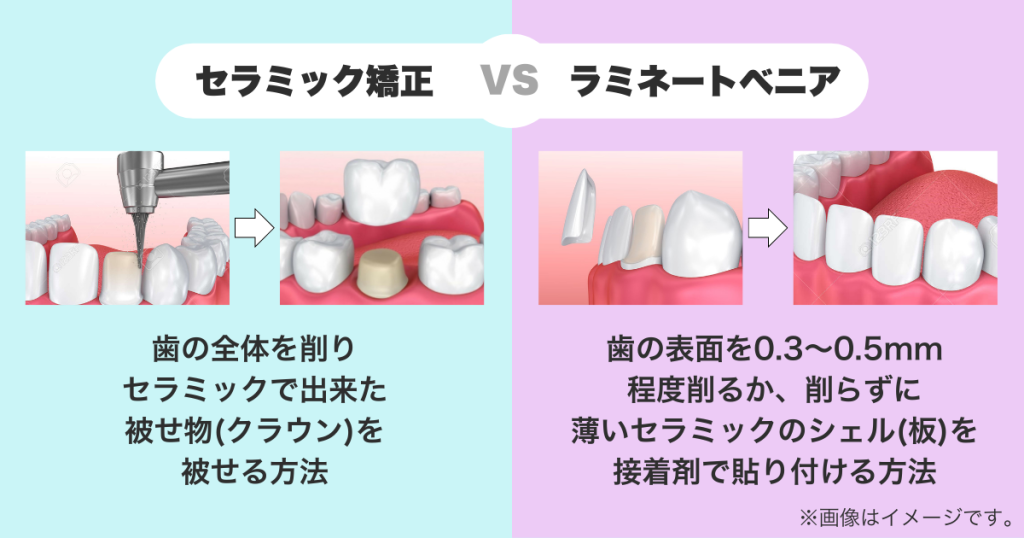 ラミネートべニア