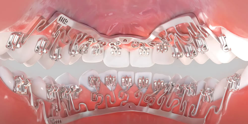 裏側矯正(舌側矯正)の装置イメージ|目立ちにくいワイヤー矯正
