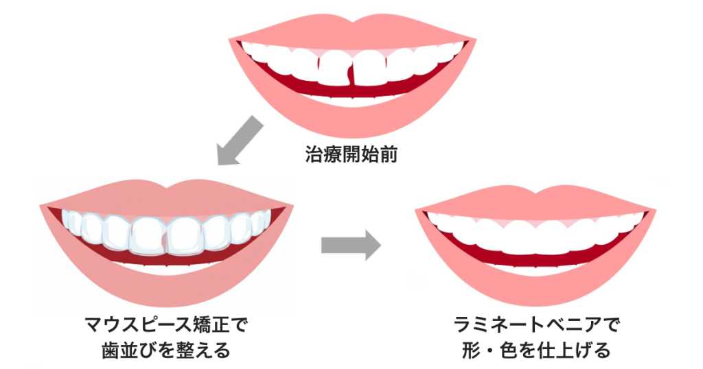 韓国式ラミネートベニアとは？矯正とベニアを組み合わせた短期歯並び改善法
