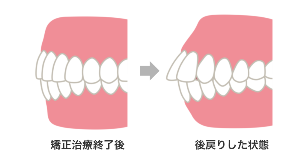 矯正治療後に起こりうる後戻りのイメージ