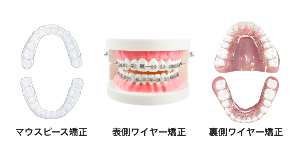 矯正治療の方法と種類一覧｜マウスピース矯正・ワイヤー矯正