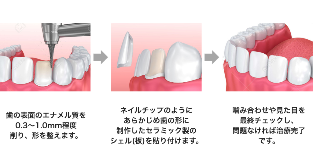 ラミネートベニアとは?短期間で歯の形や色を整える方法