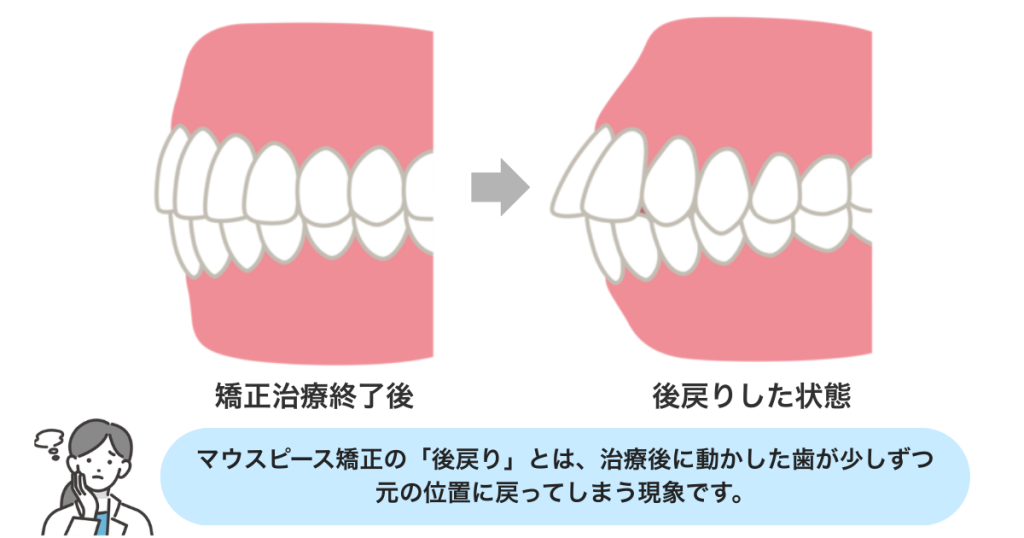 矯正治療後の後戻りリスク｜リテーナーと保定の重要性